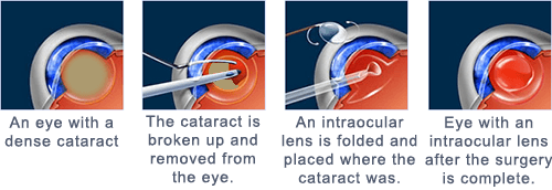 Cataract Surgery