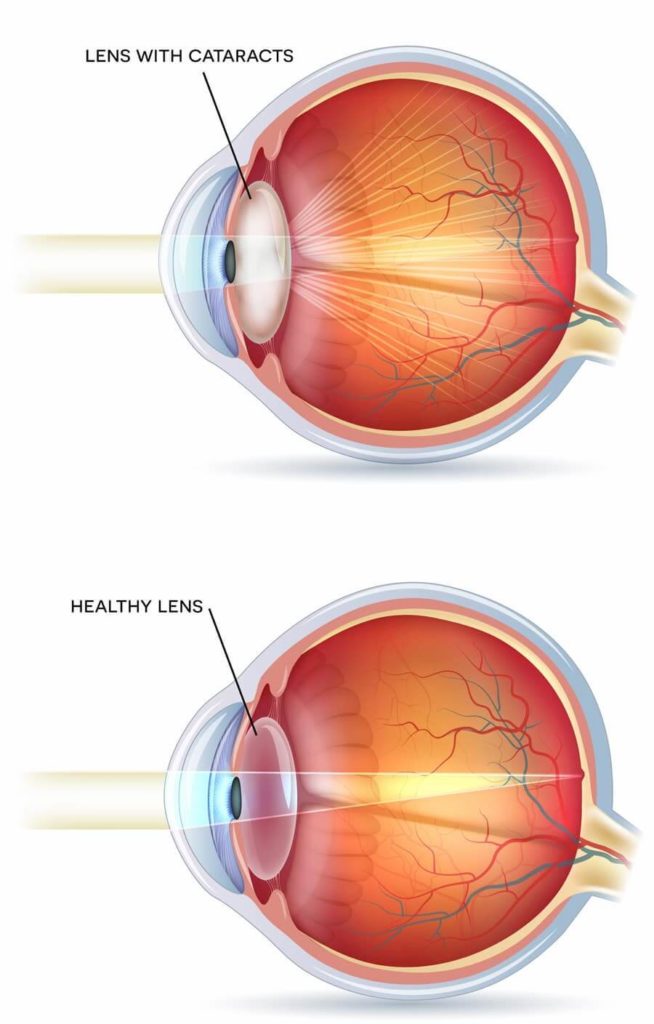 Cataract Chart