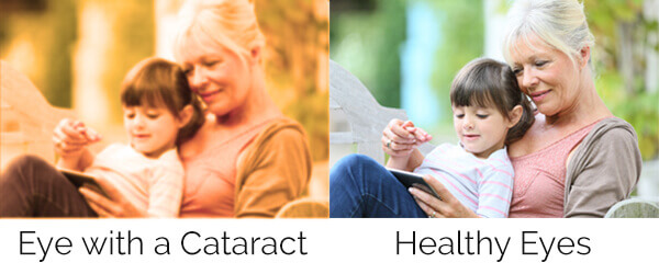 CataractScene