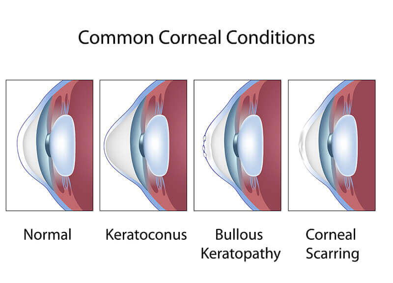 CornealConditions