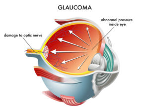 Glaucoma Chart