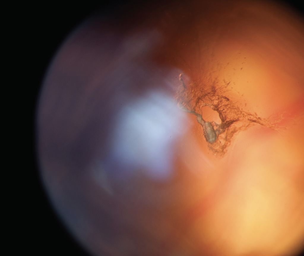 Laser Floater Removal Boston Eye Group