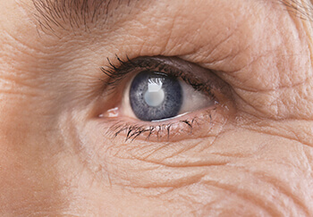 Cataract in Eye