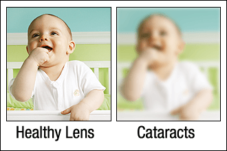 Healthy Eyes vs Cataracts