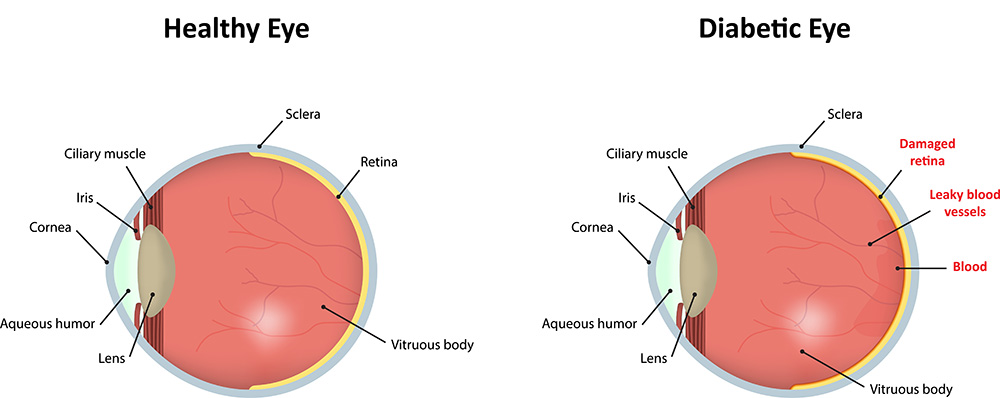 Retina Damage Chart