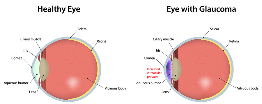 Chart Showing a Healthy Eye Compared to One With Glaucoma