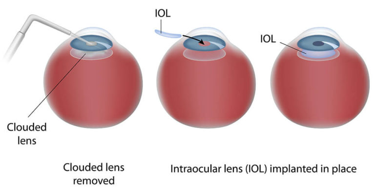 intraocular-lenses-iols-information-boston-eye-group