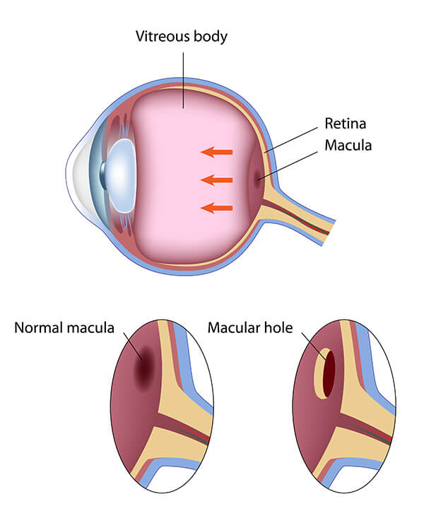 Macular Chart