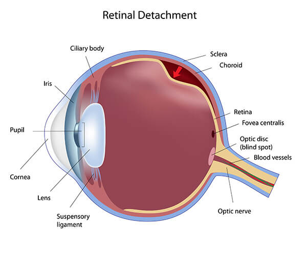Chart Showing a Retinal Detachment in an Eye